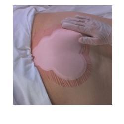 MEDICAZIONE IDROCELLULARE ADESIVA STERILE CONFORMATA PER LA REGIONE SACRALE ASSORBENTE IN SCHIUMA DI POLIURETANO ALLEVYN SACRUM 22,5X22,1CM 10PZ - Farmacianuova.eu